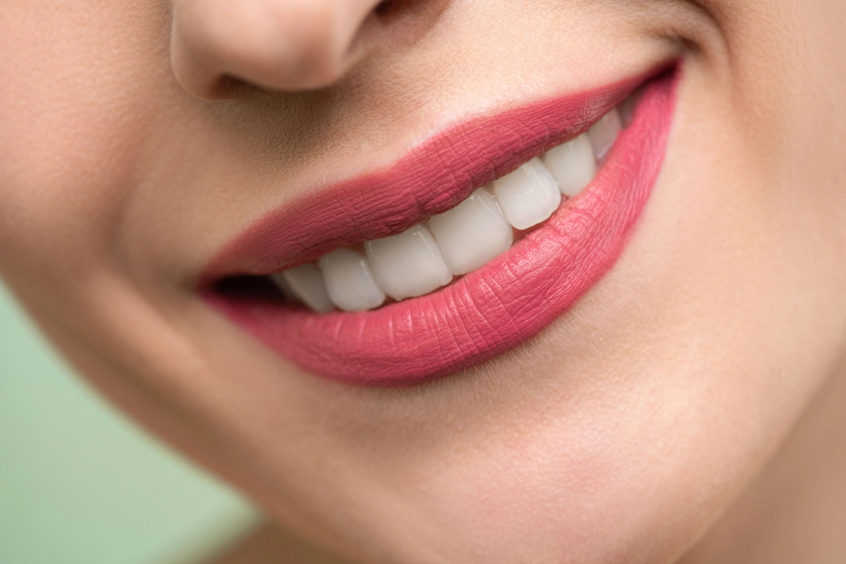 Caries blancas en los dientes: qué significan y cuándo preocuparse
