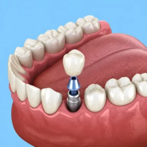 implante dental unitario
