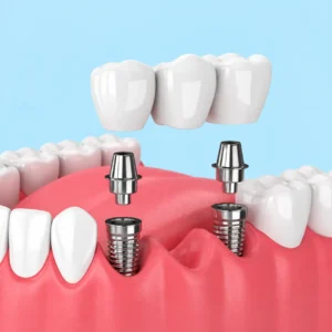 implante puente dental