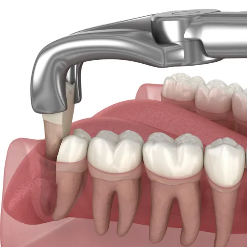 Extracciones dentales complejas