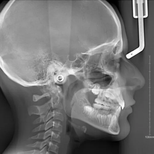 Radiografía cefalométrica