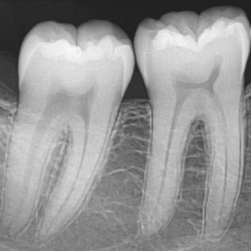 Radiografía periapical