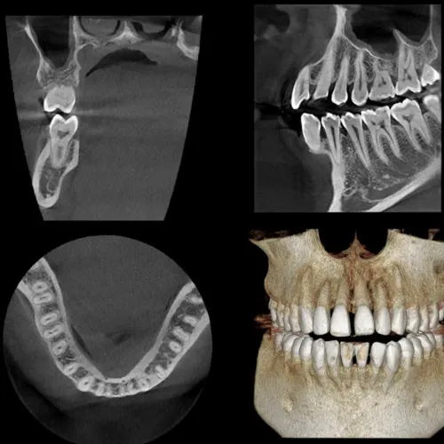 Tomografía dental 3D (Cone Beam)